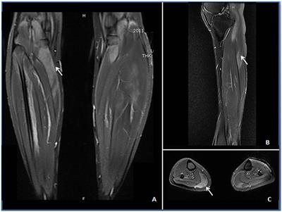 Severe Recurrent Necrotizing Myopathy in Pregnancy: A Case Report